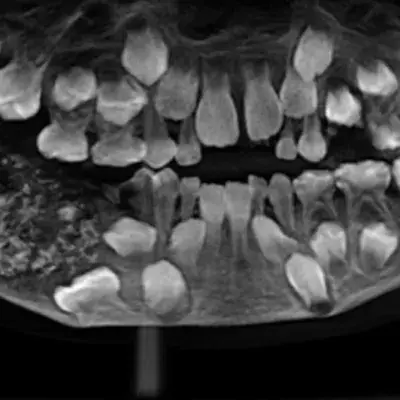 A young boy had 526 teeth removed from his mouth