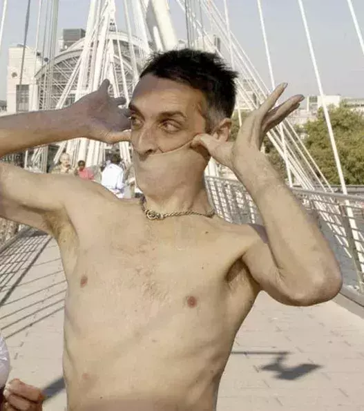 This man Gary Turner has the world’s most elastic skin. Impressive and disgusting at the same time.